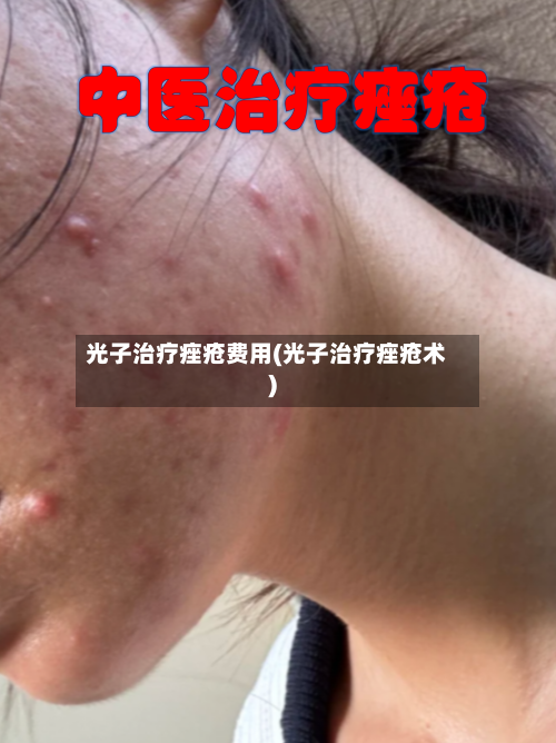 光子治疗痤疮费用(光子治疗痤疮术)-第2张图片